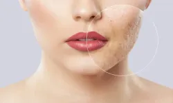 Sivilce izleri nasıl geçer? Dermatologlar açıkladı!